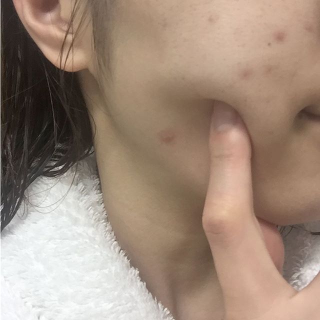 そのしこりはニキビではないかも 顔にできるしこりにはどんな物 そのしこりはニキビではないかも 顔にできるしこりにはどんな物